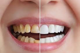 2 Fluoride treatments