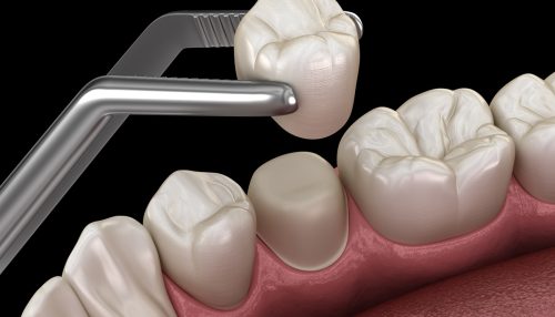 Preparated premolar tooth and dental crown placement. Medically accurate 3D illustration