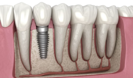 Dental Implants