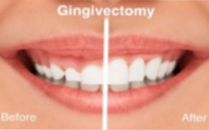 Gingivectomies