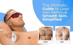 Laser Hair Removal