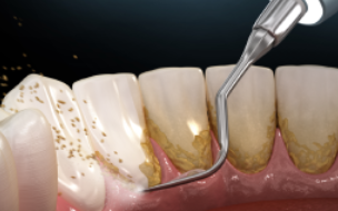 Scaling and Root Planing