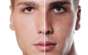 Skin Brightening Treatments