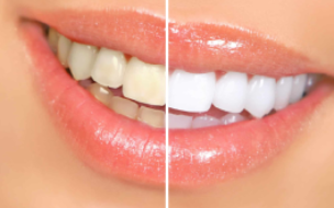 Teeth Whitening